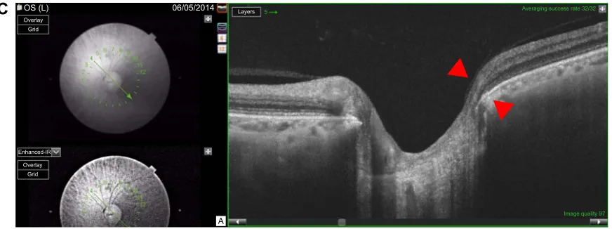 Figure S2 example of a left eye with early paracentral loss.Notes: The corresponding visual field test is shown in Figure 1 left side