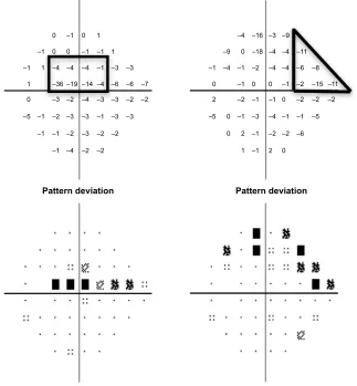 Figure 1 Examples of patterns of VF loss on HVFs (Swedish Interactive Threshold Algorithm 24-2) as defined in this study.Notes: Pattern deviation plots from left eyes are shown