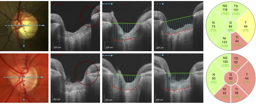Figure 2 Quantitative assessment of the Onh with ss-OCT in an eye with early paracentral loss and in an eye with isolated peripheral loss.Notes: Top row shows an eye with early paracentral loss: disc photograph (left), minimal BMO-MrW =34.8 μm (center left