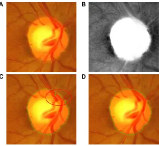 Figure 3 The disc segmentation procedure for JPg images (Bin rushed): (A) localized fundus image, (B) inpainted image, (C) first level set, (D) the localized image based on the first level set (is split from the middle), (E) second level set, (F) optimized disc contour.