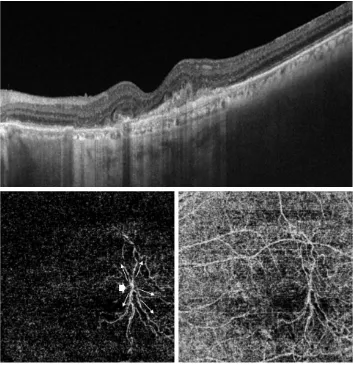 Figure 4 Upper, ss-OCT of the left eye of an 80-year-old male with aMD. Marked disorganization of the outer retina with marked thinning of the rPe and choriocapillaris and minimal intra-retinal fluid accumulation are shown