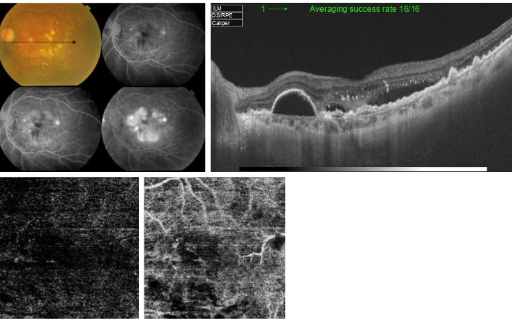 Figure 7 Upper left, color photo and FFA of the left eye of a 32-year-old female with high myopia and sub-foveal hemorrhage