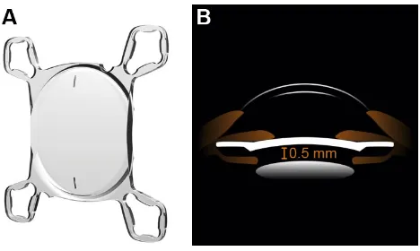 Figure 1 Design (A) and sulcus location (B) of the addOn® secondary iOl.Notes: (A) addOn iOl, toric marks visible