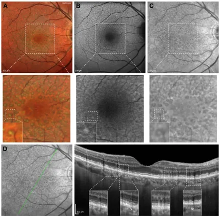 Figure 1 Multicolor imaging, FAF, iR and SD-OCT of a patient affected by RPD.Notes: (A) Multicolor imaging showing a yellowish–green reticular pattern and some RPD with a target appearance characterized by a more intense yellowish/greenish core surrounded 