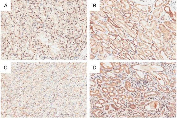 Figure 1. Representative immunohistochemistry images of CHD9 expres-sion in ccRCC tissues and their para-carcinoma tissues: A