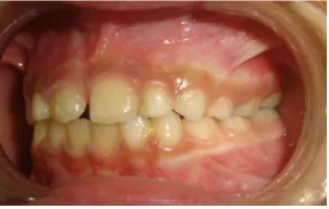 Figure 5. Right side-intraoral view. 