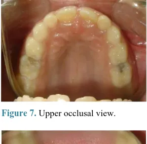 Figure 7. Upper occlusal view. 
