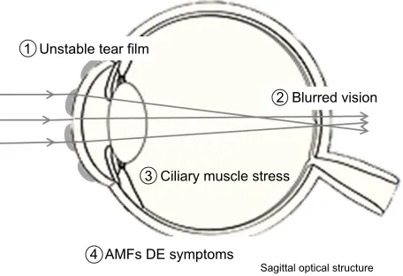 Figure 4 The mechanism of occurrence of dry eye symptoms. image defocus due to tear instability represents visual impairment.Note: Blurring may possibly cause ciliary muscle spasms, which eventually induce aMF and cause De symptoms including ocular fatigue.Abbreviations: AMF, accommodative microfluctuation; DE, dry eye.