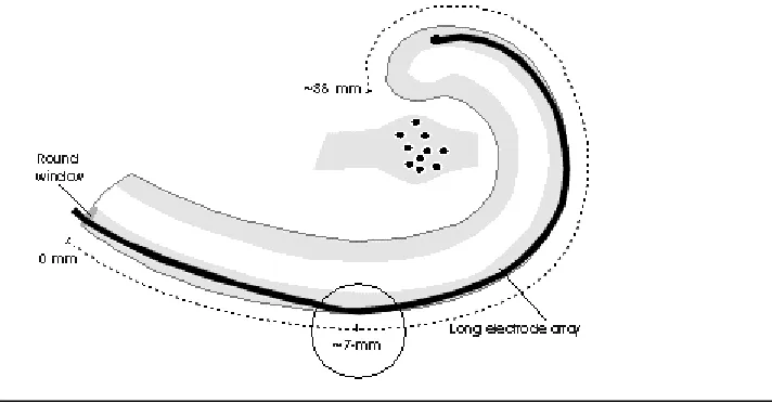 Figure 12 Long electrode insertion into cochlea scraping membrane wall 