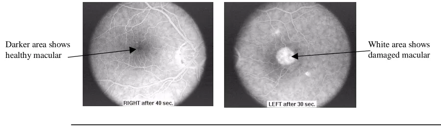 Figure 2.2Fundus image of healthy retina (left) compared with maculardegeneration case (right)3.