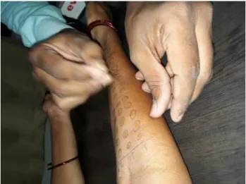 Figure 1: Performing SPT on volar aspect of forearm  of patient. 