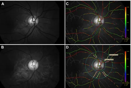 Figure 1 Fundus images at two different wavelengths of light obtained by Oxymap T1 and the oxygen saturation map analyzed by Oxymap analyzer.Notes: Oxymap T1 simultaneously captures 50° monochrome images centered at the optic disk at two different waveleng