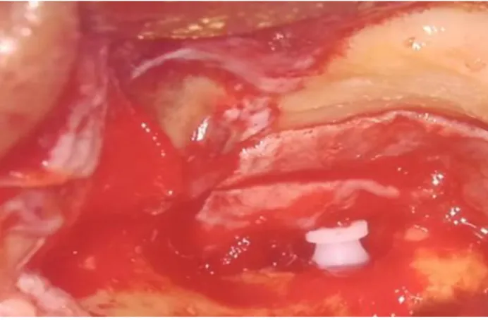 Figure 1: Grommet placed over the stapes head.  For ossicular reconstruction we used grommet of 0.9 mm  inner  diameter  made  of  Teflon