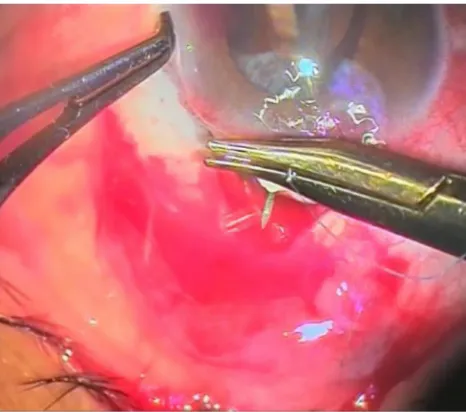 Figure 9 gonioscopy showing the tube in the anterior chamber.