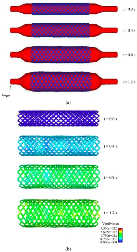 Figure 9. The initial conditions applied to the fluid domain: constant pressure difference (P2 − P1) is applied from the ca- theter to the fluid boundaries