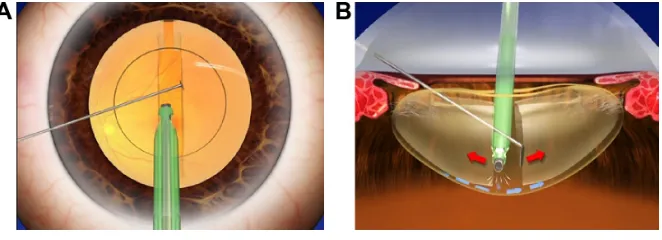 Figure 1 Posterior ih technique.Notes: after the phaco tip is passed under the anterior capsule within the possible range, a vertical groove is sculpted in accordance with the divide and conquer method (A)