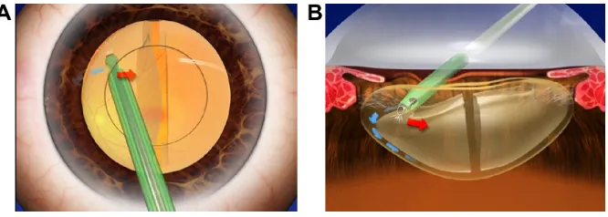 Figure 2 anterior ih technique.Notes: Following the placement of the phacoemulsification tip under the capsulorhexis edge, the aqueous humor is vacuumed and/or the side-port is depressed to induce irrigation flow into the anterior cortical-capsular layer (