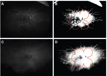 Figure 1 reperfusion in eye of a 61-year-old male, following treatment with 5 injections of ranibizumab.fluorescein angiogram; and Notes: Preinjection fluorescein angiography (A–C) shows ischemia and abnormal neovascularization (A, preinjection fluorescein