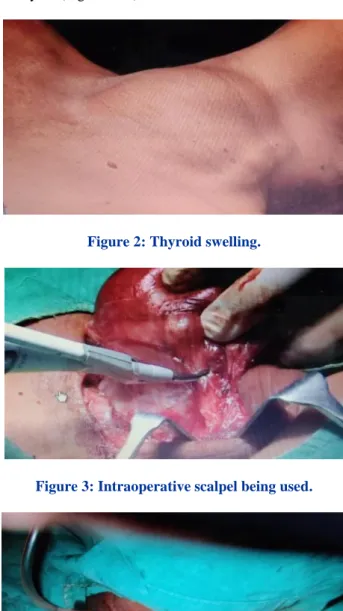 Figure 2: Thyroid swelling. 
