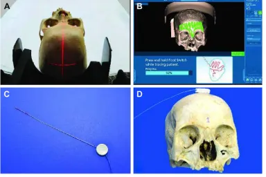 Figure 1 Techniques in navigation enabling of human cadaveric skulls.Notes: external photograph showing computed tomography acquisition of the skulls as per standard navigation protocols (A)