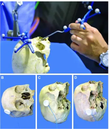 Figure 2 Techniques in navigation enabling of human cadaveric skulls.Notes: external photographs of the skulls showing the optically enabled model with head frame (A) and various positions of the dynamic reference frame at superior frontoparietal suture (B), pterions (C), and mastoid (D).