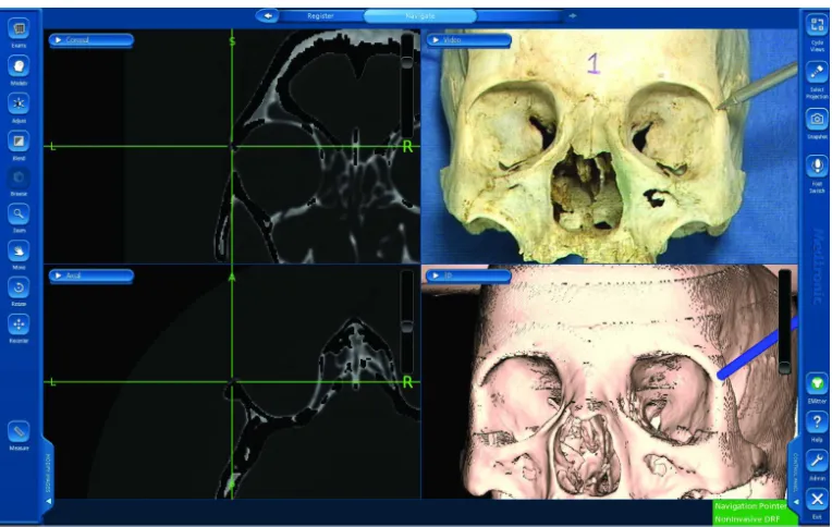 Figure 6 active navigation of the sutures.Note: Four-window active navigation image showing localization of the frontozygomatic suture.Abbreviations: l, left; r, right; DrF, dynamic reference frame.