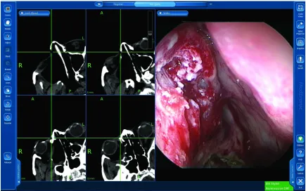 Figure 3 The “look ahead” software window with simultaneous endoscopic view. note that the bony nasolacrimal duct is expected 15 mm ahead in the same direction from the current location of the endoscope (extreme right window).