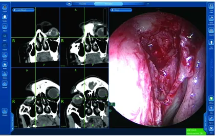 Figure 5 The “look ahead” software window with simultaneous endoscopic view. The CT window is at 5 mm (right upper) showing the cross hair passing through the center of the lacrimal sac