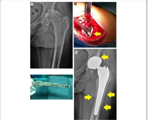 Fig. 2 amay be press-fit inserted according to a normal procedure (shows optimal bone osteointegration (hydrogel is applied on the sanded titanium surface of a standard cementless hip prosthesis, both on the stem and Radiographic antero-posterior view of s