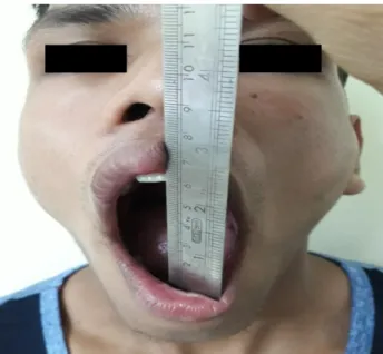 Figure 1: Bilateral TMJ dislocation and jaw deviation  on full mouth opening. 