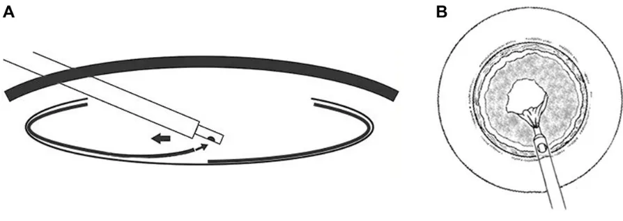 Figure 1 Schema of the technique of central cortical clean-up in eyes with severe zonular dehiscence and miosis.Notes: (A) Cross-section; (B) front view
