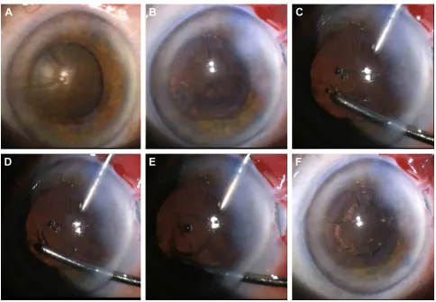 Figure 3 Capsular phimosis is present at the 2-month follow-up with uncorrected visual acuity of 20/25.