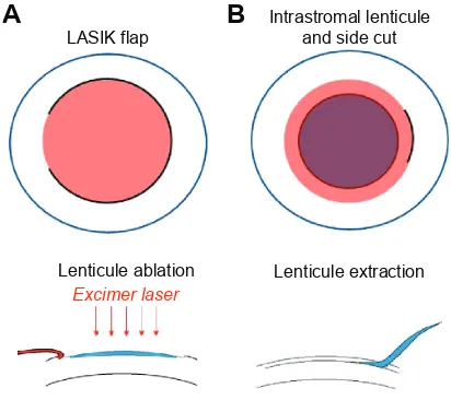 Figure 1 Schematic drawings of LASiK (A) and SMiLe (B).Abbreviations: LASiK, laser-assisted in situ keratomileusis; SMiLe, small-incision lenticule extraction.
