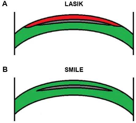 Figure 3 Comparison of LASIK flap (A) and SMiLe cap (B). The anterior stroma is relatively stronger in SMiLe.Abbreviations: LASiK, laser-assisted in situ keratomileusis; SMiLe, small-incision lenticule extraction.