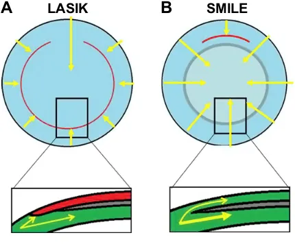 Figure 4 Corneal nerves (arrows) in LASiK (A) and SMiLe (B).