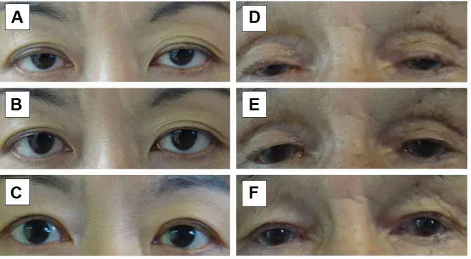 Figure 3 Case report of two patients.Notes: (A, D) Preoperative condition. (B, E) Processed images predicting postoperative appearance
