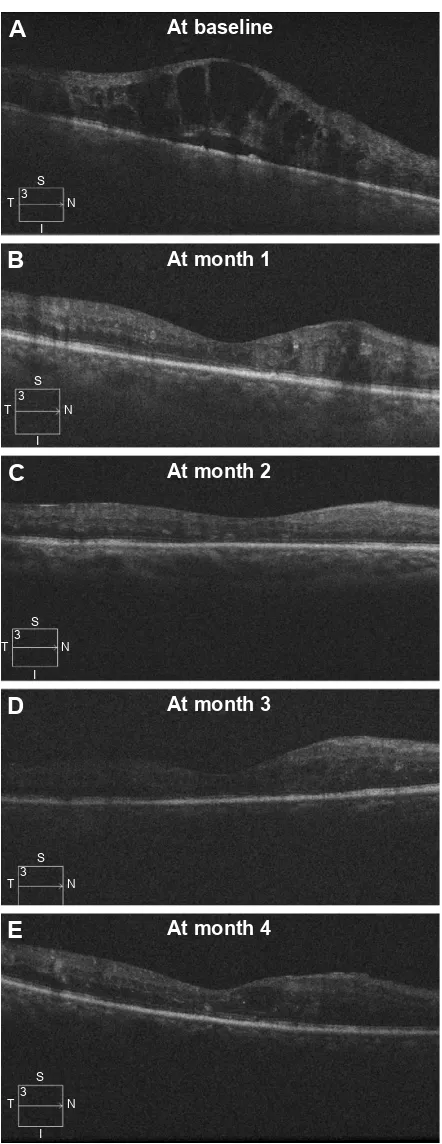 Figure 1 Serial linear OCT scan after intravitreal ziv-aflibercept injections.Notes: a 65-year-old male developed macular edema due to a CrVO