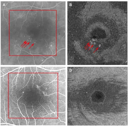 Figure 1 Identification of MAs on FA and SS-OCT.Notes: Fa (A, C) and two of the corresponding ss-OCT slabs (average 21 slabs reviewed per eye) (B, D) of a right eye with nonproliferative diabetic retinopathy