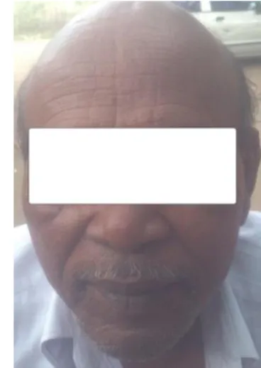 Figure 1. Aging face with wrinkles 