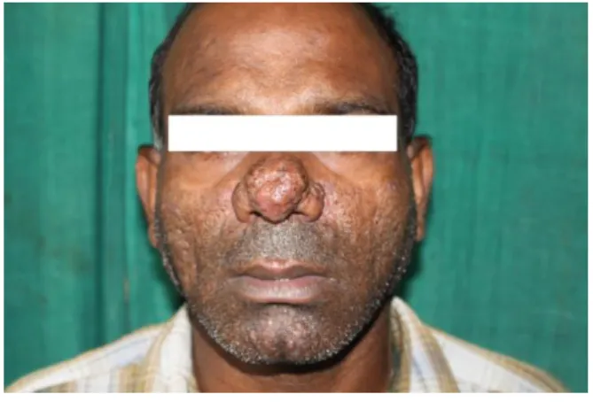 Figure 6. Black hairy nevus of the face 