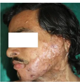 Figure 8. Post-burn hypertrophic scar on the face 