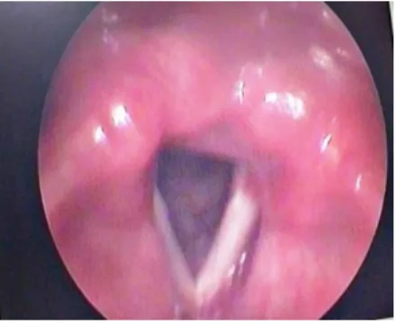 Figure 2: Bilateral arytenoid congestion with left  vocal cord thickening. 