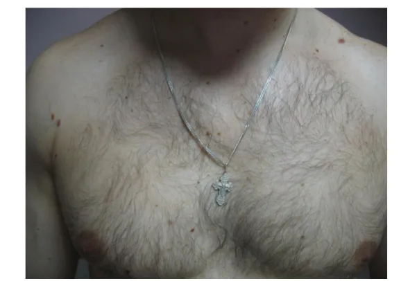 Figure 1. The chest area rated as a second location among psoriasis patients and patients of the monitored group 