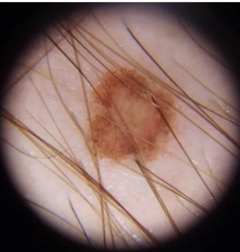 Figure 4. Large melanocytic nevi with pseudopods 