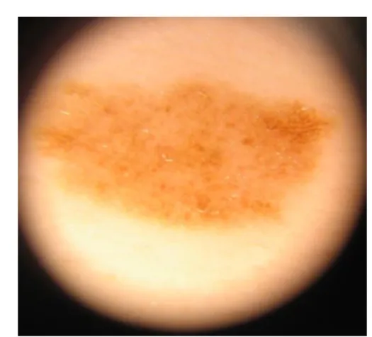 Figure  5.  Dysplastic  nevi  characterized  by  Pehamberger  crite- crite-ria 
