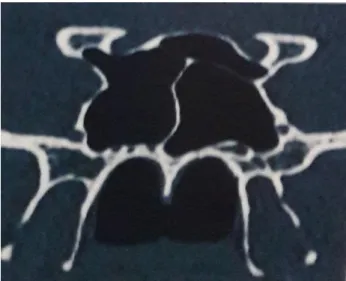 Figure 2: Left onodi cell with optic nerve bulge in its  lateral wall. 