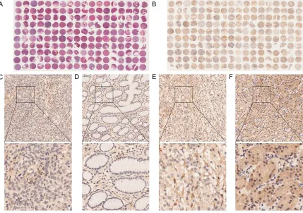 Figure 2. TOB1 expression in gastric cancer and adjacent normal tissues. (A) The gastric cancer tissues and ad-jacent normal tissues were confirmed by haematoxylin and eosin staining