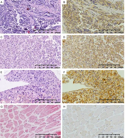 Figure 1. Immunohistochemical staining of c-MET expression in RMS and normal muscle tissues