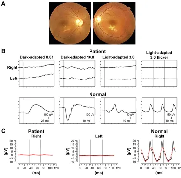 Figure 2 scatterplots showing the relationship between the results obtained by the reTeval™ and conventional erg in patients with cone dysfunction.Notes: There was a significant positive correlation in the amplitude (r=0.576, P,0.001, n=35; Pearson correla