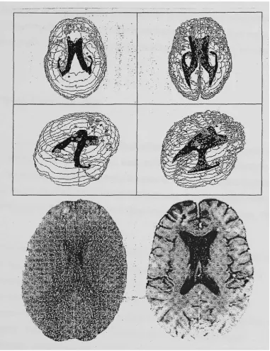 Figure 2. Neuroanatomical changes after TBI:frontal regions. Adapted fromenlarged lateral ventricles which is an indication of tissue degeneration in the representation above